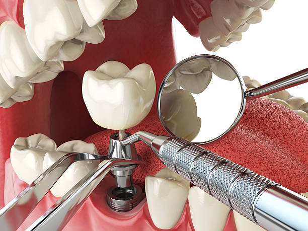 Best Emergency Treatment for Dental Infections or Abscesses in Wacousta, MI